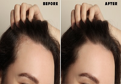 Avoiding hair transplant procedure is possible Heres how you can  efficiently cure hair problems without going for hair transplant procedure   Fox Interviewer