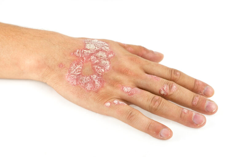 psoriasis hand fingers rash crust scales - Depositphotos_162281662_xl-2015