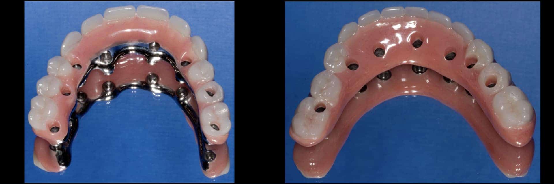 Failure Of All Upper And Lower Teeth, Replaced With Dental Implants ...