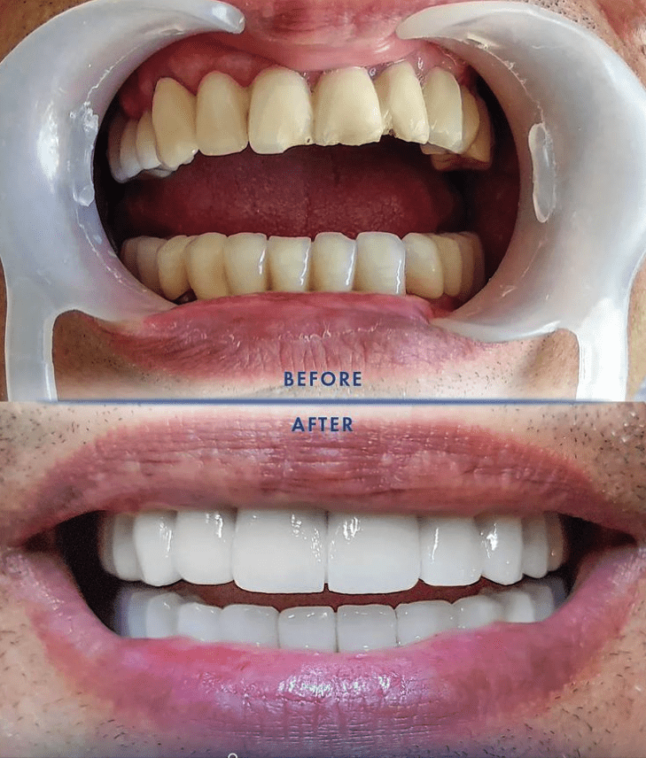 How Much Do Veneers Cost in Turkey l Veneers in Turkey l HCT