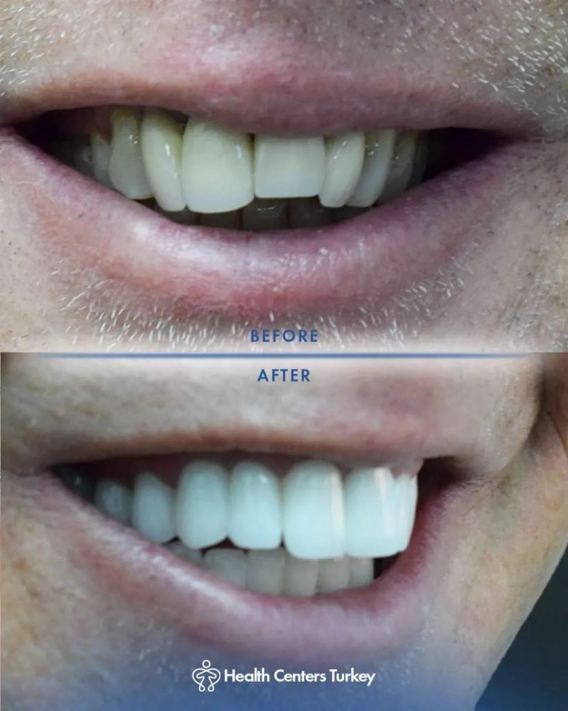 How Much Do Veneers Cost in Turkey l Veneers in Turkey l HCT