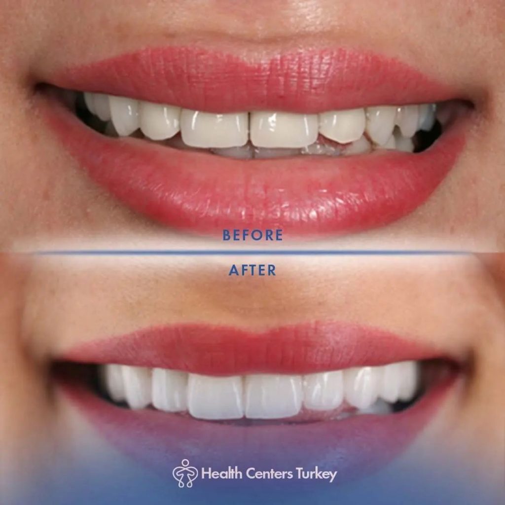 How Much Do Veneers Cost in Turkey l Veneers in Turkey l HCT