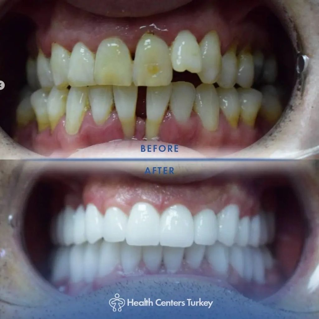 How Much Do Veneers Cost in Turkey l Veneers in Turkey l HCT