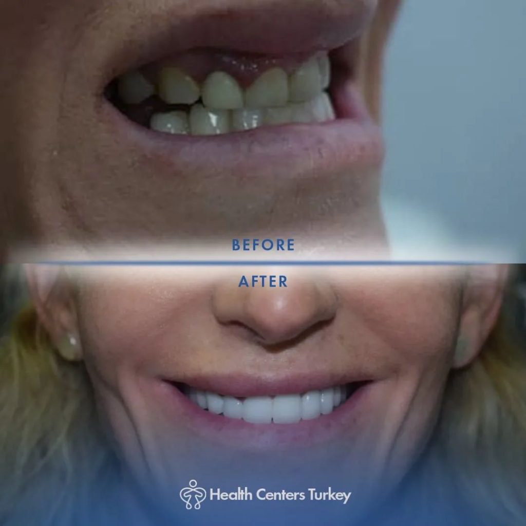 How Much Do Veneers Cost in Turkey l Veneers in Turkey l HCT