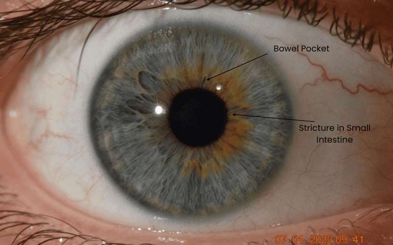 Iris Examples Health Saves
