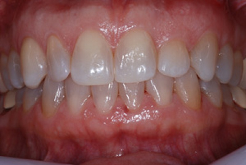 Before Teeth whitening treatment - Dental care