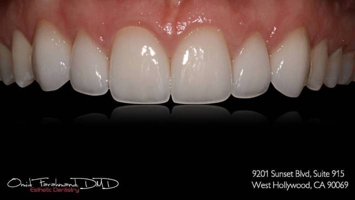 Esthetic Dentistry - West Hollywood