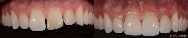 Composite Fillings Treatment - Dentistry