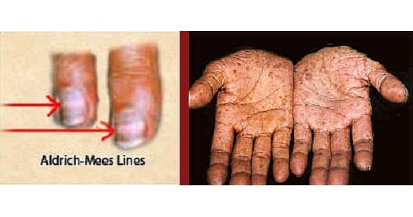 arsenic poisoning fingernail signs