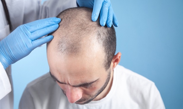 Frequently asked questions about Hair transplant