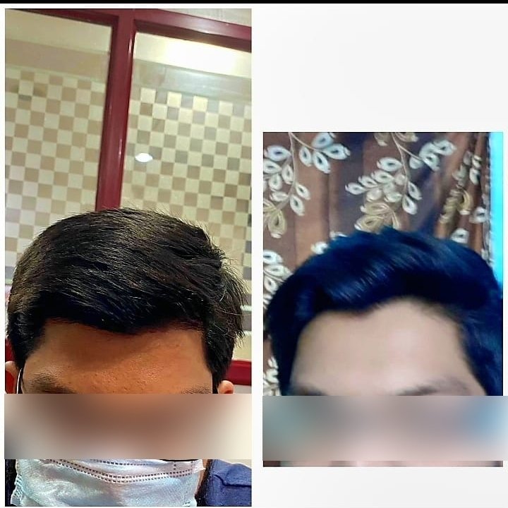 hair-treatment-4