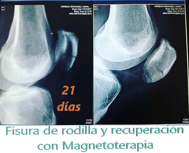 Magnetoterapia en fisura de rodilla. Recuperación