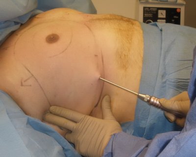 liposcultura per ginecomastia